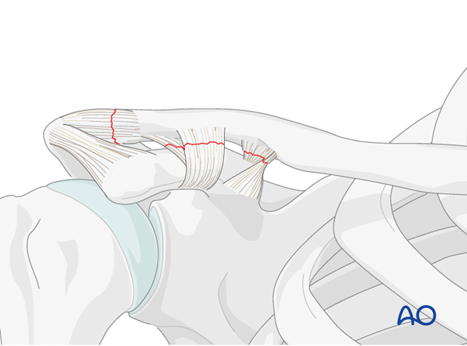 Ligament reconstruction