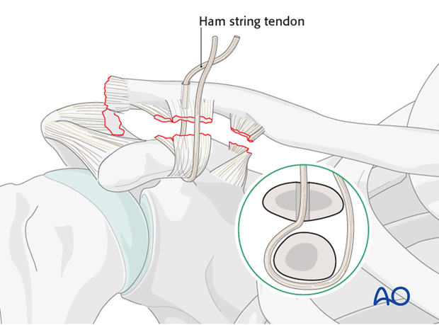ligament reconstruction