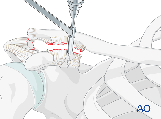 Ligament reconstruction