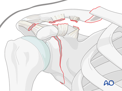 Floating shoulder - Sequence of repair