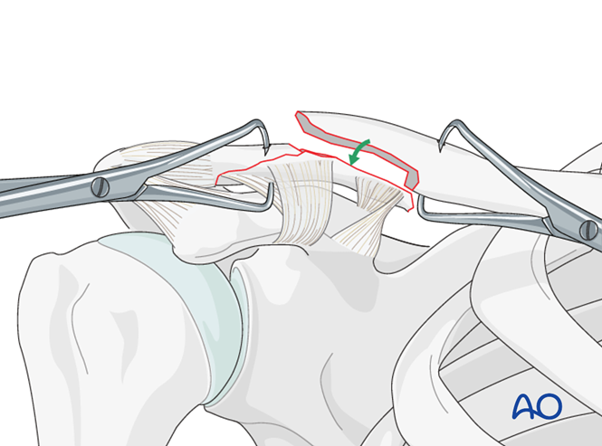 ORIF - Pre-contoured distal plate for Lateral, displaced fracture with ...