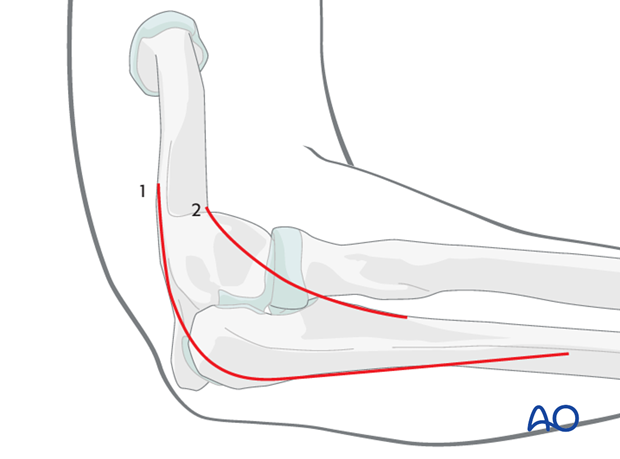 Repair lateral collateral ligament - Exposure
