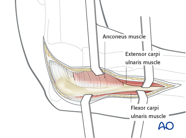 Boyd approach – Posterior surface of ulna