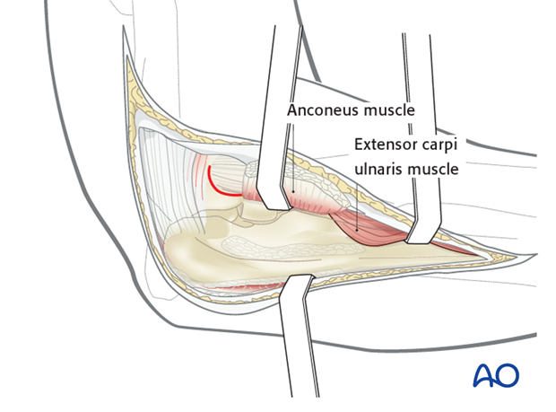 Boyd approach – Osteotomy of lateral humeral epicondyle