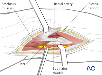 Anterior approach to the proximal forearm