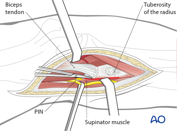 anterior approach