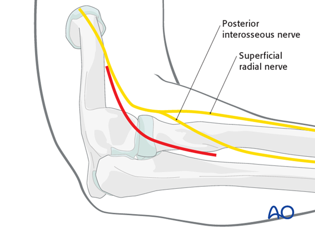 Lateral approach to proximal forearm – Kocher – Kaplan - Incision