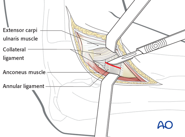 Lateral approach to proximal forearm – Annular ligament