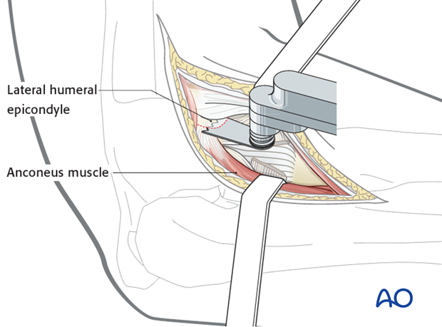 Lateral approach to proximal forearm – Kaplan – Kocher – Osteotomy of lateral epicondyle