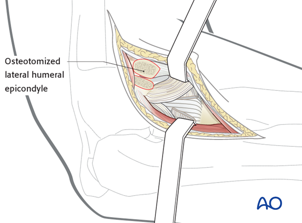 Lateral approach to proximal forearm – Kaplan – Kocher – Osteotomy of lateral epicondyle