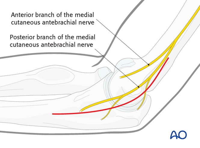 Repair of medial collateral ligament