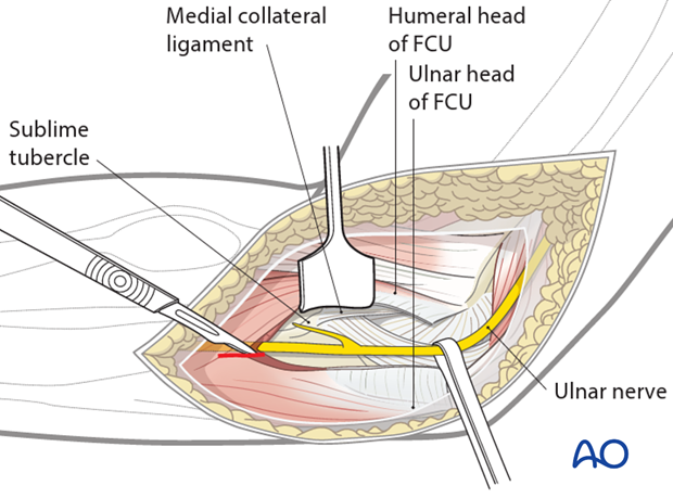 medial fcu split