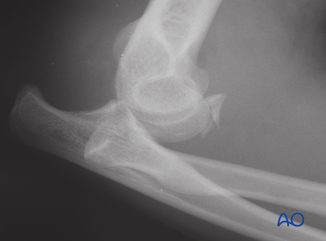 Terrible triad - Elbow dislocation with fractures of radial head and ...