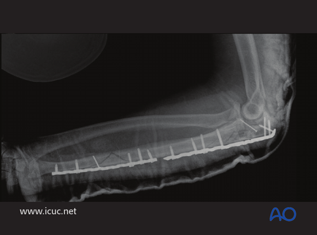 open reduction internal fixation