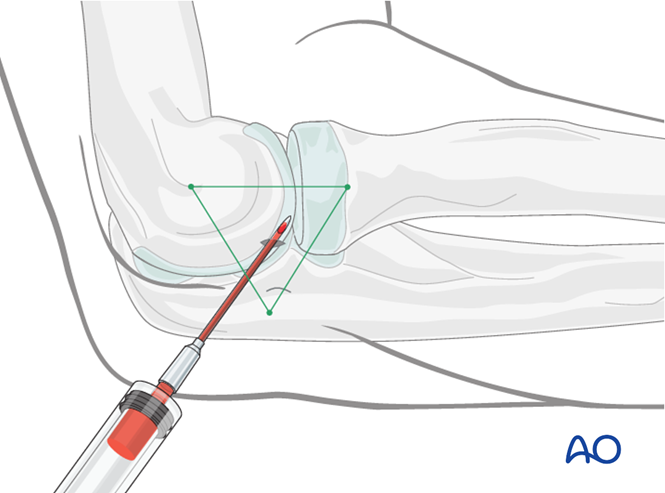 Nonoperative for Ulna, complete articular