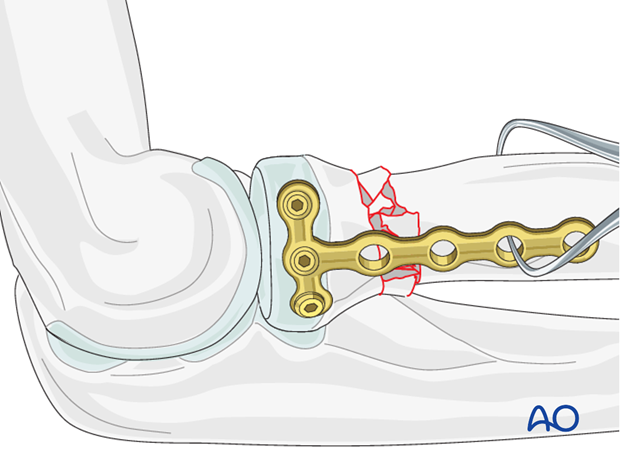 Multifragmentary radial neck – Bridge plate – Indirect reduction