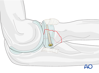 Lag screw for Radius, partial articular