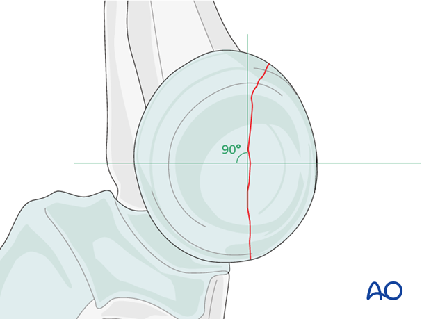 Radial head lag screw direction