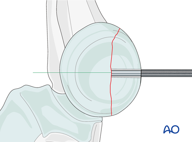 Radial head lag screw – Drill sleeve