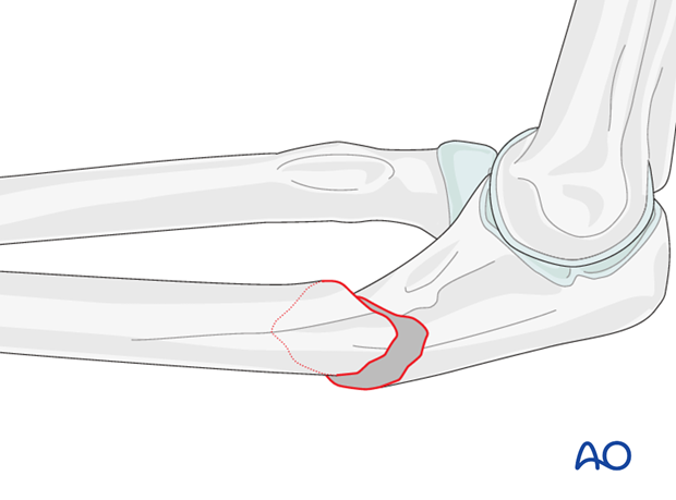 Ulna oblique metaphyseal – Lag screw with protection plate – Cleaning fracture site