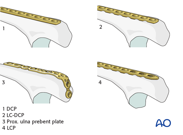 Ulna oblique metaphyseal – Lag screw with protection plate – Plate selection