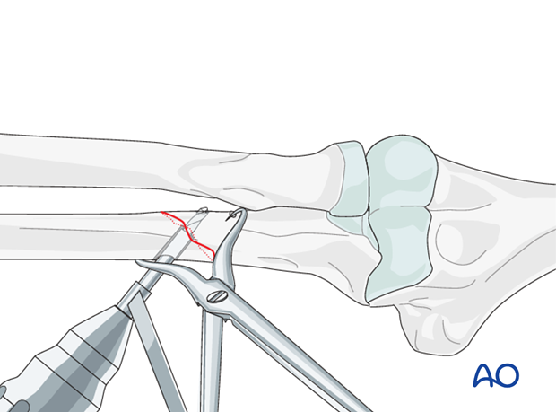 Ulna oblique metaphyseal – Lag screw with protection plate - Drilling