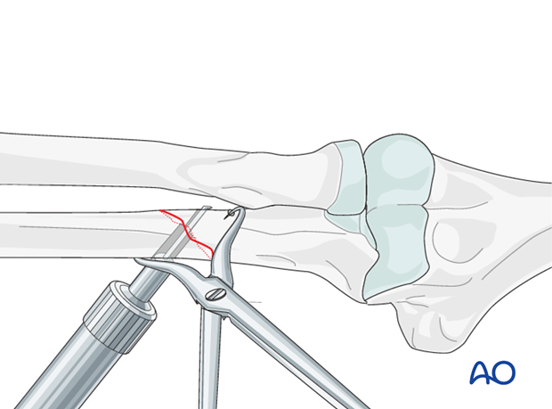 Ulna oblique metaphyseal – Lag screw with protection plate - Measuring