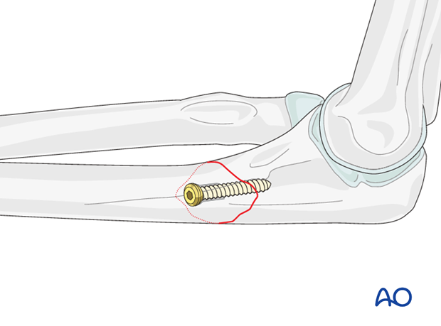 Ulna oblique metaphyseal – Lag screw with protection plate – Lag screw insertion