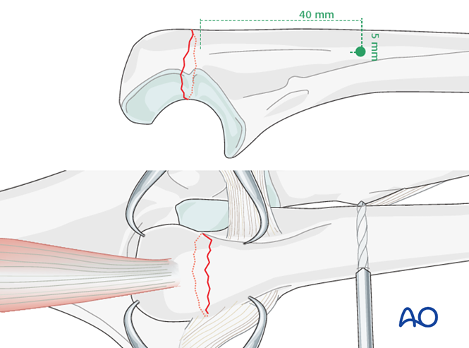 Tension band wiring for Ulna, articular, olecranon