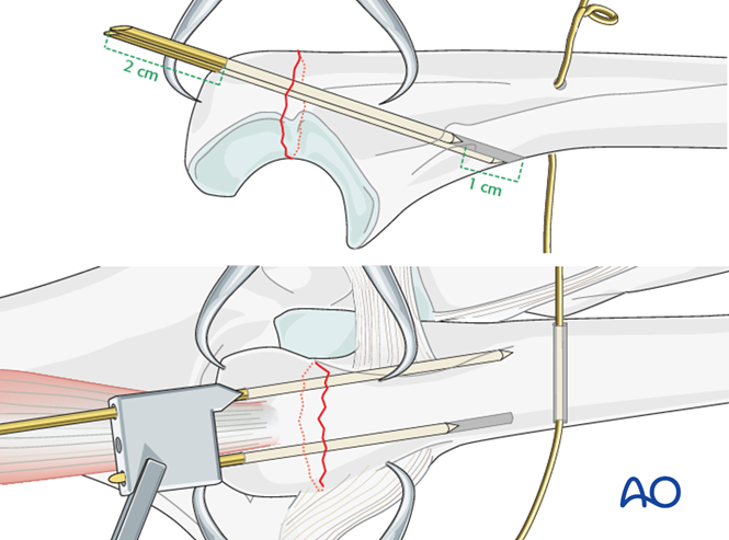 Tension band wiring for Ulna, articular, olecranon