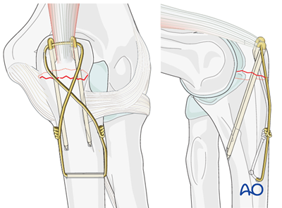 Tension band wiring for Ulna, articular, olecranon