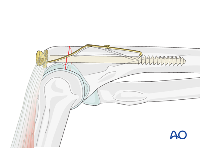 Tension band wiring for Ulna, articular, olecranon
