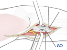 radius extraarticular avulsion of bicipital tuberosity