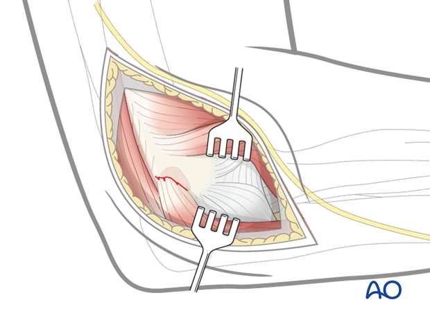 Repair lateral collateral ligament - Positioning