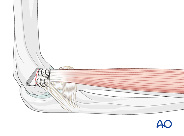 Repair lateral collateral ligament – Suture repair