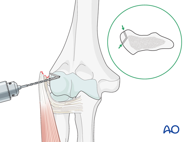 Repair lateral collateral ligament – Suture repair