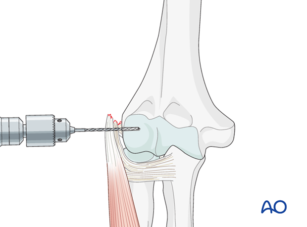 Repair lateral collateral ligament – Anchor fixation