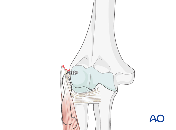 Repair lateral collateral ligament – Anchor fixation