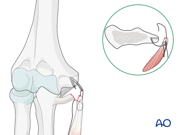 Repair of medial collateral ligament – Suture repair