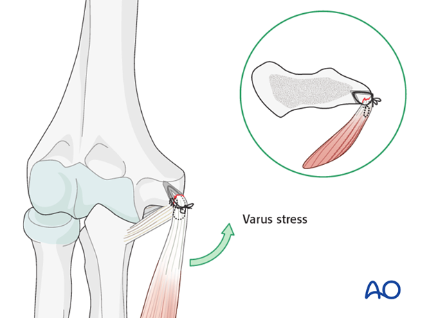 Repair of medial collateral ligament – Suture repair