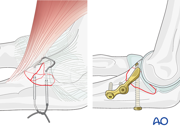 Lasso suture repair and lag-screw fixation with buttress plate of a coronoid fracture