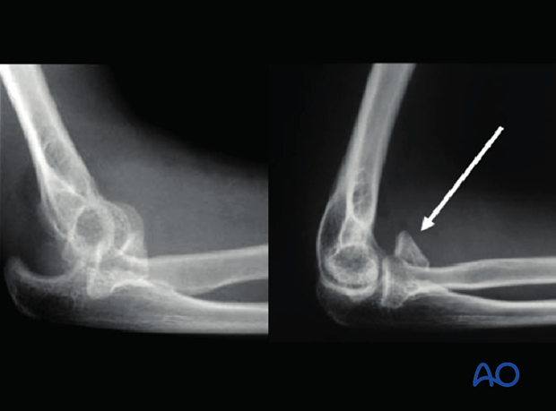 coronoid process radiograph