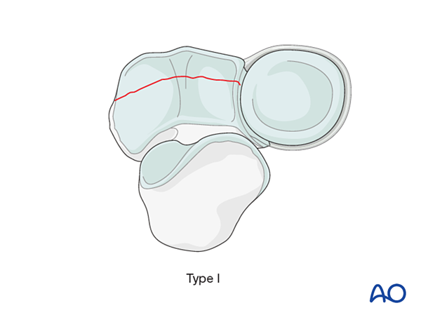 repair of coronoid fracture