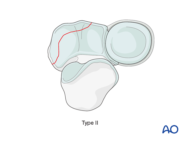 approach to the le fort i level of the midface in cleft lip and palate patients