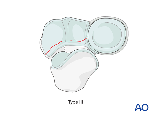 approach to the le fort i level of the midface in cleft lip and palate patients