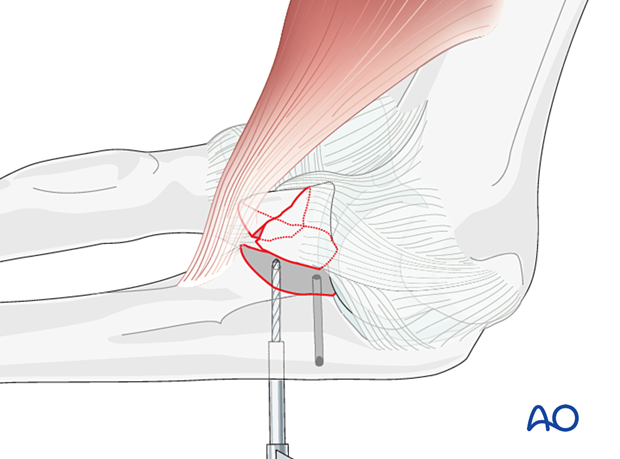 repair of coronoid fracture