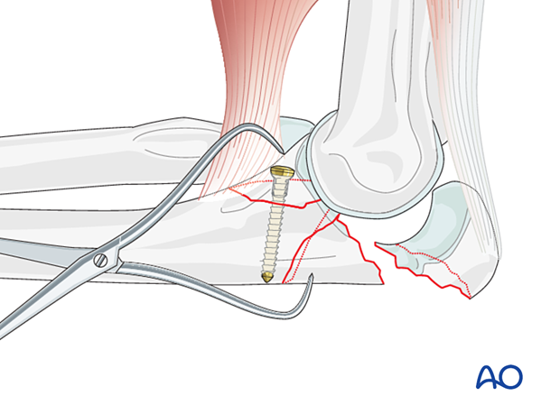 repair of coronoid fracture