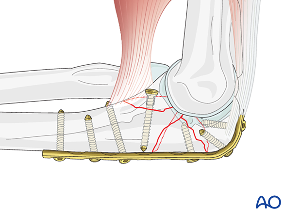 repair of coronoid fracture