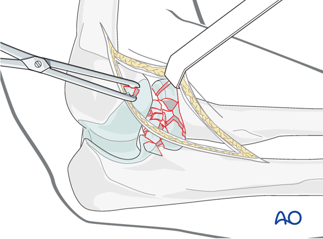 Radial head arthroplasty for Radius, complete articular