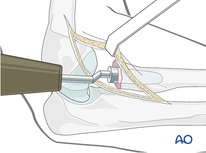 Radial Head Arthroplasty For Radius, Complete Articular